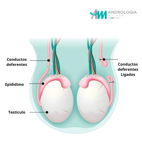 Imagen ilustrativa de la vasectomía masculina, mostrando los testículos, el epidídimo y los conductos deferentes cortados para evitar la fertilización.